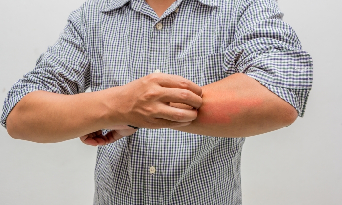 วิธีแก้ผื่นคัน สาเหตุของผื่นคัน และการป้องกัน
