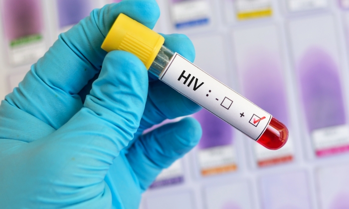 เอดส์ อาการ เริ่มต้น เป็นอย่างไร และควรดูแลตัวเองอย่างไร