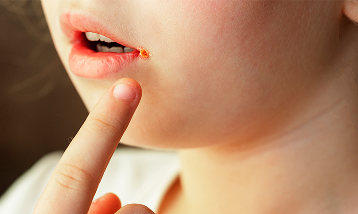 ปากนกกระจอก รักษา และป้องกันได้อย่างไร