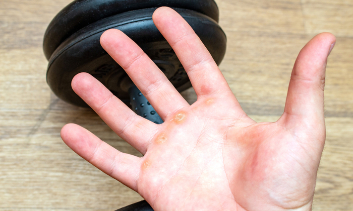 ตาปลาเกิดจากอะไร มีวิธีรักษาอย่างไร