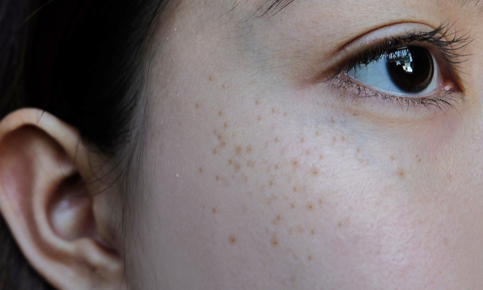 Seborrheic keratosis (กระเนื้อ) คืออะไร มีวิธีการรักษาอย่างไร