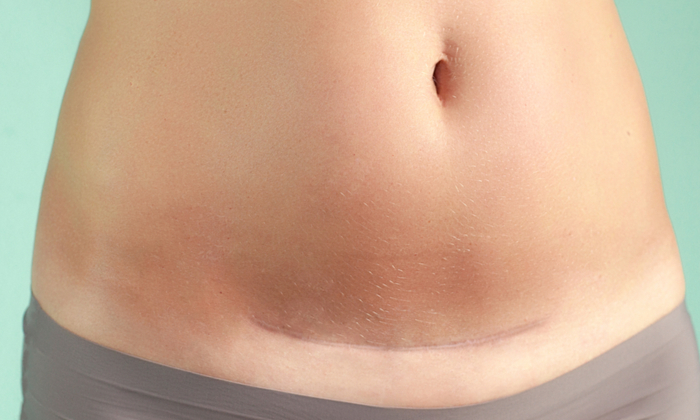 แผลผ่าคลอดอักเสบข้างใน สาเหตุและการดูแล