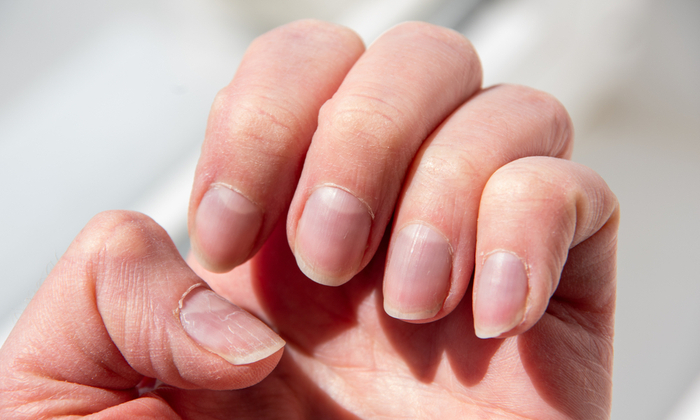 เล็บ ขาดสารอาหาร เป็นอย่างไร แบบไหนเรียกว่าผิดปกติ