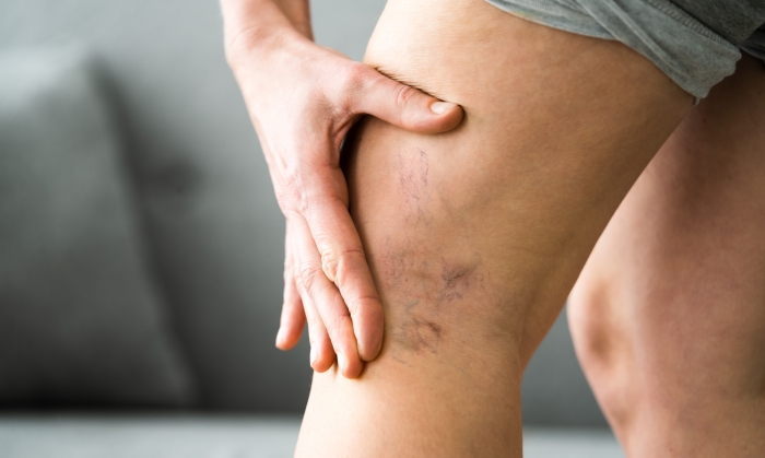 ขาลาย เกิดจากอะไร รักษาได้อย่างไร