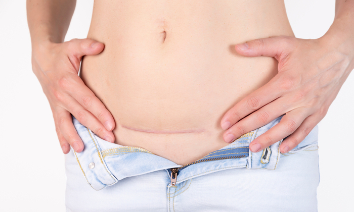 แผลผ่าคลอดปริ เกิดจากอะไร คุณแม่ควรดูแลแผลอย่างไร