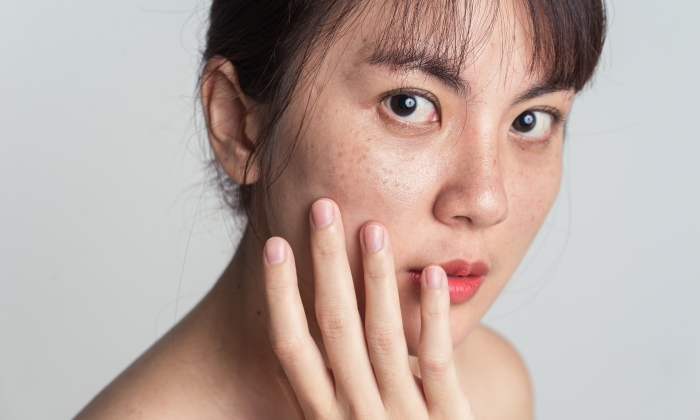 กระ เกิดจากอะไร ต่างจากไฝอย่างไร อันตรายหรือไม่