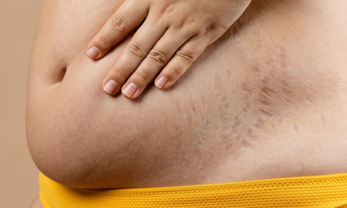 ท้องลายหลังคลอด เกิดจากอะไร และควรดูแลอย่างไร