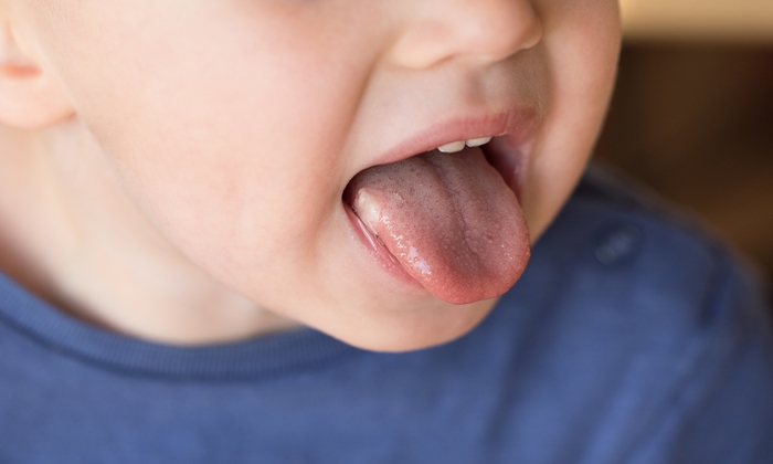 วิธีรับมือเมื่อลูกลิ้นเป็นร้อนใน