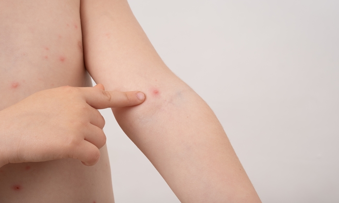 เมื่อลูกเป็น อีสุกอีใส ควรดูแลอย่างไร