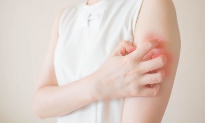 ผื่นคันเกาแล้วลาม เกิดจากสาเหตุใด  รักษาได้ด้วยวิธีใดบ้าง