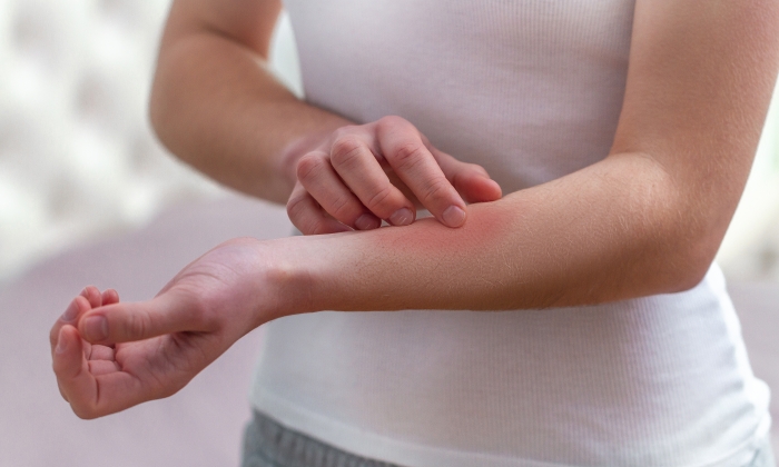 ผื่นแพ้อากาศ เกิดจากอะไร ป้องกันอย่างไร