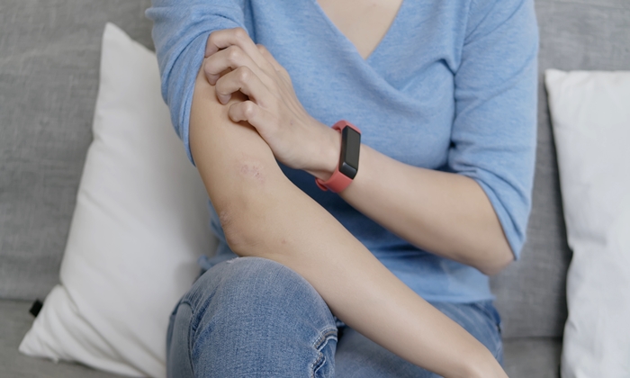 หมัดคน อาการ วิธีรักษา และวิธีป้องกัน