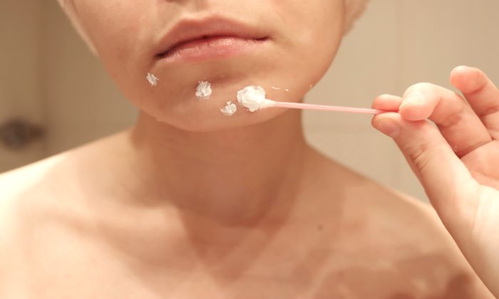 เป็นสิวที่คาง สาเหตุ วิธีรักษา และการป้องกัน