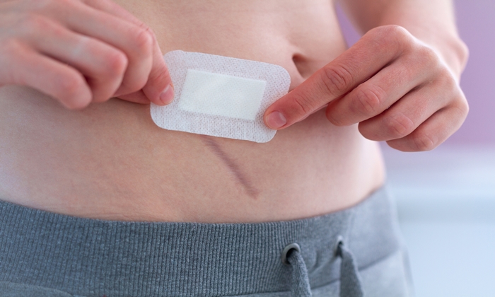 แผลผ่าตัด ควรดูแลอย่างไร