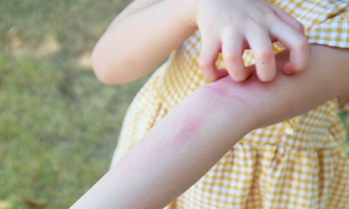 ไข้เลือดออก อาการ สาเหตุ การรักษา และการป้องกัน