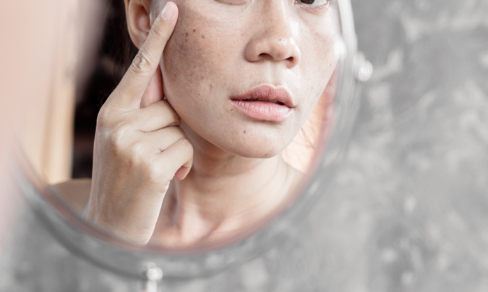 หน้าเป็นฝ้า สาเหตุ วิธีรักษาและดูแลตัวเอง