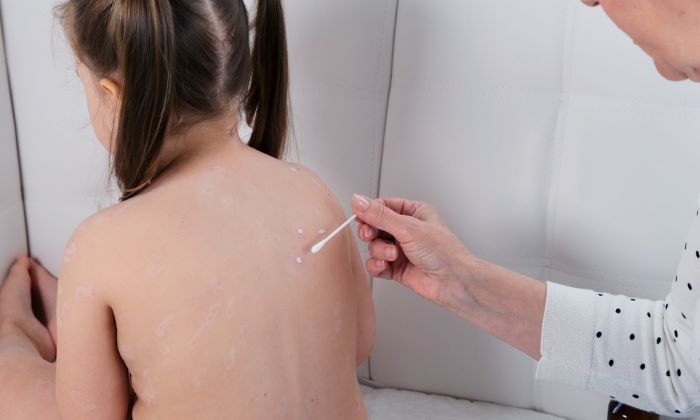 อีสุกอีใส สาเหตุ อาการ และการรักษา