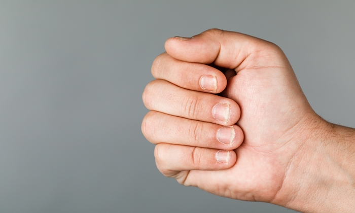 เล็บเป็นเชื้อรา สาเหตุ อาการ วิธีรักษาและวิธีดูแลตัวเอง