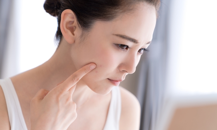 สิวเรื้อรัง เกิดจากอะไร มีวิธีรักษาอย่างไร