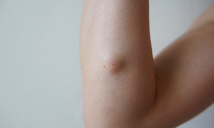 ก้อนไขมันใต้ผิวหนัง สาเหตุ อาการ วิธีการรักษา