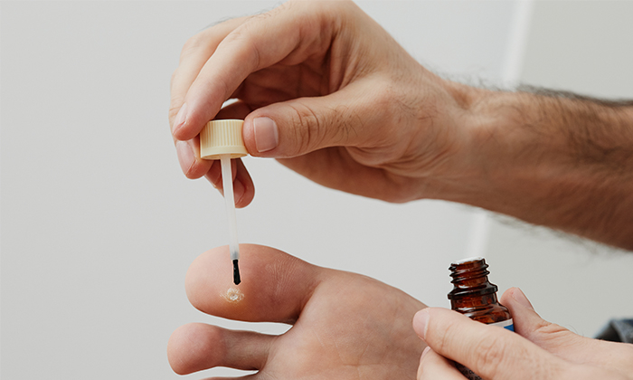 ยาทาหูด มีอะไรบ้างและใช้อย่างไร