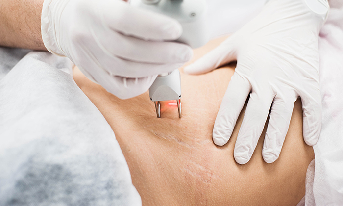 เลเซอร์รอยแตกลาย ข้อดี ข้อเสีย และข้อควรระวัง