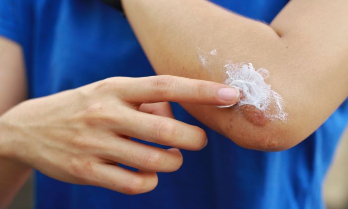 แผลคีลอยด์ สาเหตุ การรักษาและการป้องกัน