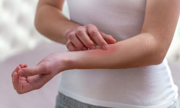 ผื่นแพ้ฝุ่น มีอาการอย่างไร และรักษาอย่างไรได้บ้าง