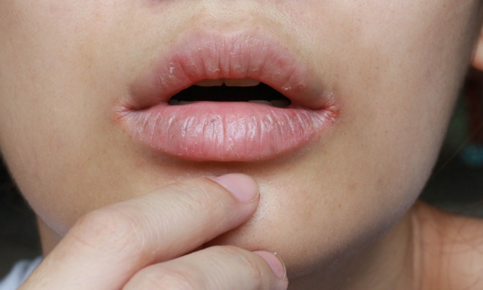 ปากแตก สาเหตุ อาการ และวิธีดูแลตัวเอง