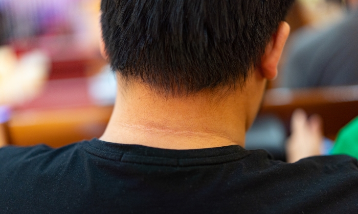 คอดํา เบาหวาน เกี่ยวข้องกันอย่างไร ป้องกันได้หรือไม่