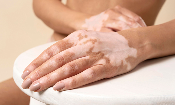 ผิวด่างขาว สาเหตุ การรักษา และการดูแลตัวเอง