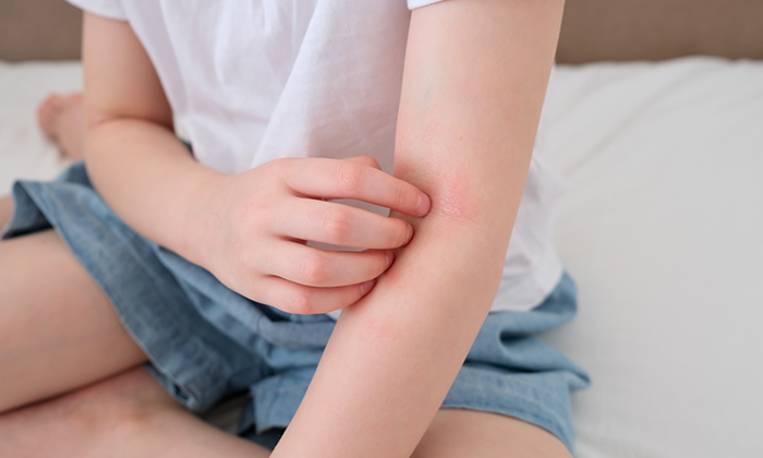 ผิวหนังอักเสบเรื้อรัง สาเหตุ ภาวะแทรกซ้อนและการดูแลรักษา