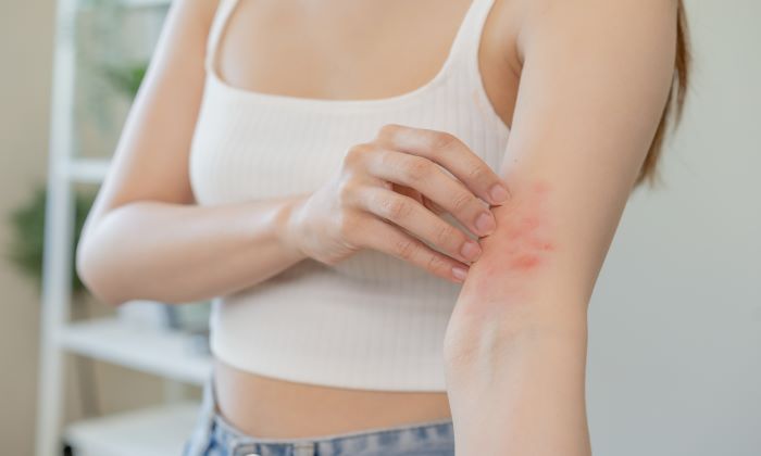 ผื่นเชื้อรา สาเหตุ อาการ และการรักษา