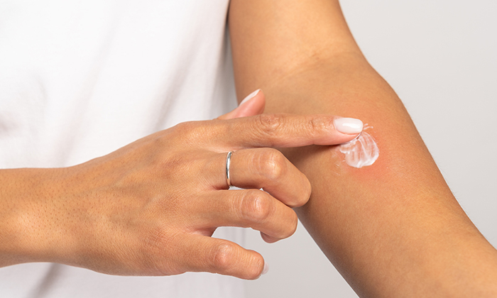 ยาแก้แพ้ ผื่นคัน มีอะไรบ้าง และควรดูแลตัวเองอย่างไร