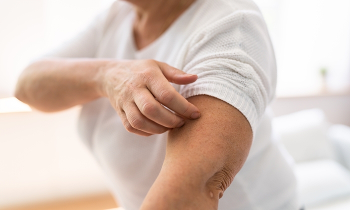 Bullous pemphigoid คือ โรคเพมฟิกอยด์ สาเหตุ อาการ วิธีรักษา