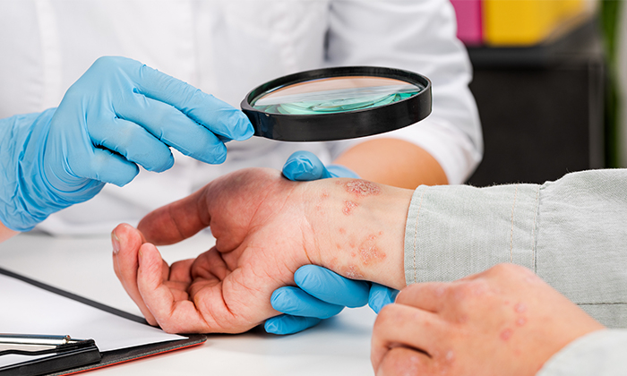 Eczema คือ อะไร สาเหตุ อาการ และการรักษา