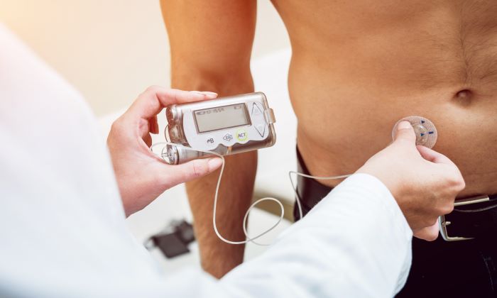 Insulin Pump คืออะไร มีประโยชน์ และวิธีใช้งานอย่างไร