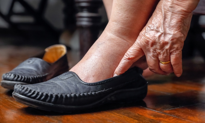 แผลเบาหวาน เท้าดำ อันตรายหรือไม่ ส่งผลต่อสุขภาพอย่างไร