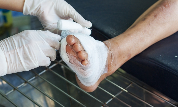 แผลเบาหวาน ตัดขา เกิดจากอะไรได้บ้าง