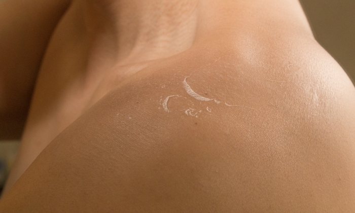 ผิวลอกเป็นขุย เกิดจากสาเหตุอะไรได้บ้าง