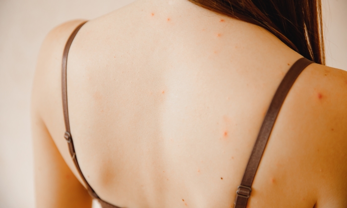 ตุ่ม PPE หรือตุ่มเอดส์ เมื่อเป็นแล้วควรดูแลตนเองอย่างไร