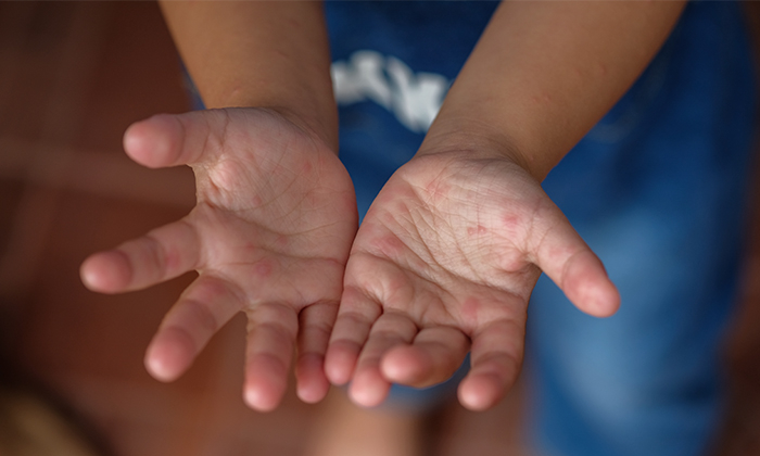 ตุ่มใสที่มือ เกิดจากอะไร และควรรักษาอย่างไร