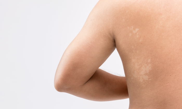 เกลื้อนแดด สาเหตุ อาการ วิธิรักษาและการป้องกัน