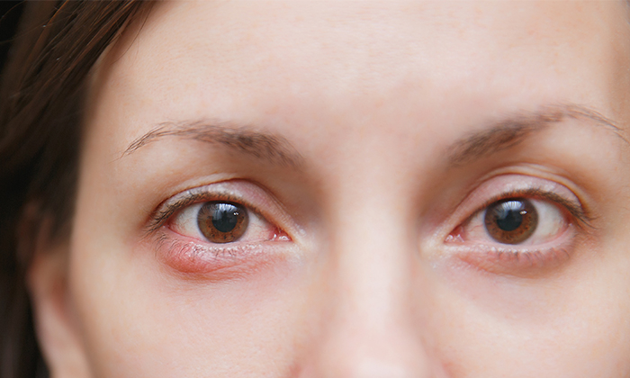 เม็ดขาว เปลือกตาด้านใน เกิดจากอะไร อันตรายหรือไม่