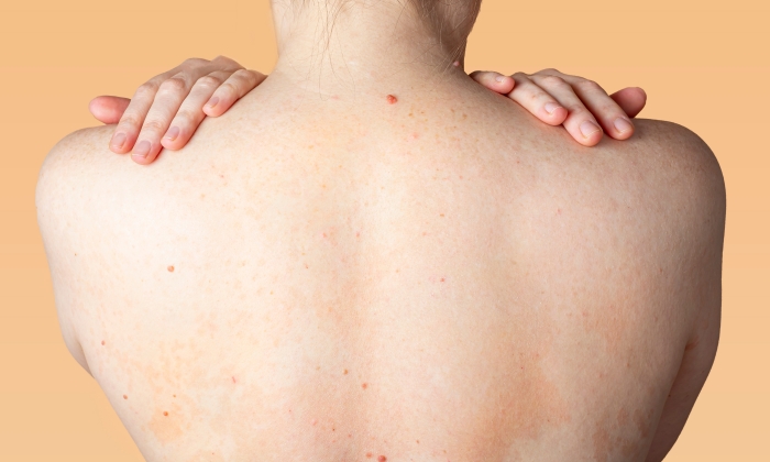 สิว ยีสต์ คืออะไร รักษาได้ด้วยวิธีใดบ้าง