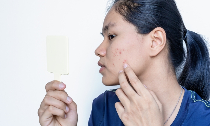 สิวฮอร์โมน รักษา ได้อย่างไรบ้าง และมีสาเหตุมาจากอะไร