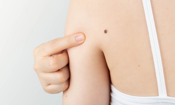 ขี้แมลงวัน เกิดจากอะไร กำจัดได้ด้วยวิธีใดบ้าง