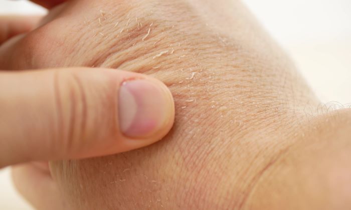 ผิวเป็นขุย สาเหตุ การรักษา และการป้องกัน