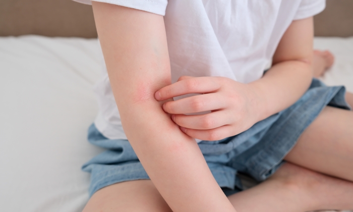 หัดกุหลาบ สาเหตุ อาการ วิธีรักษาและการดูแลตัวเอง