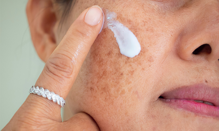 ครีมรักษาฝ้า ควรมีส่วนผสมอะไรบ้างที่ปลอดภัย